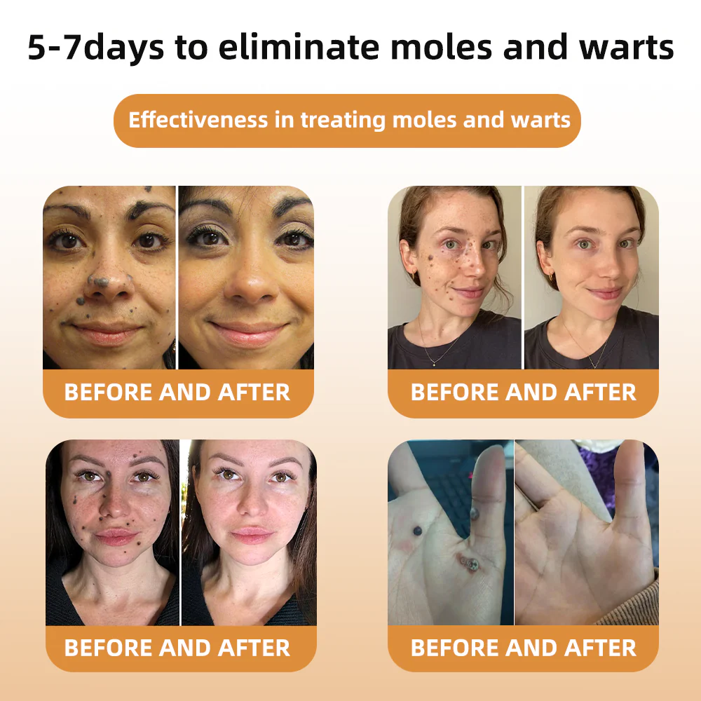 Bee Venom Wart & Tag Removal Cream - Image 3