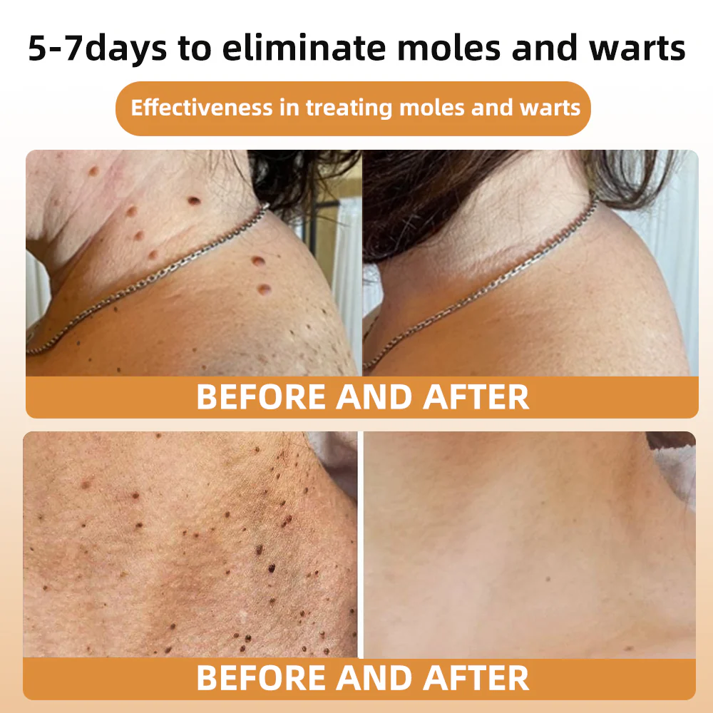 Bee Venom Wart & Tag Removal Cream - Image 4