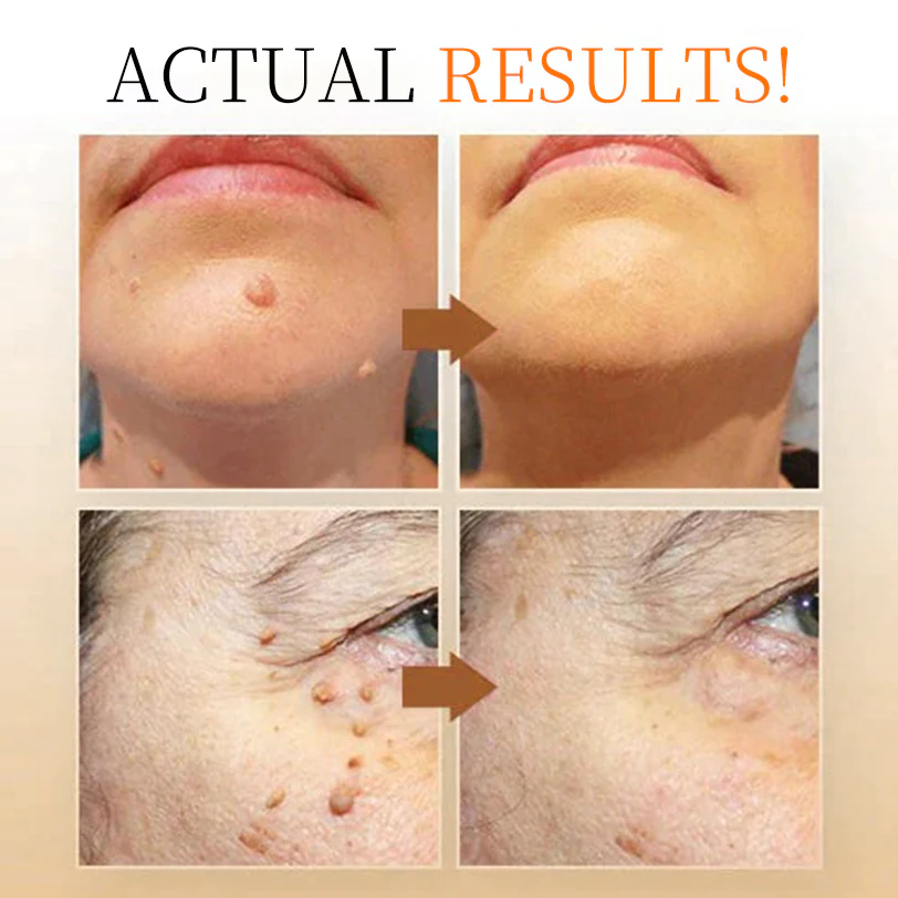 Bee Venom Wart & Tag Removal Cream - Image 7