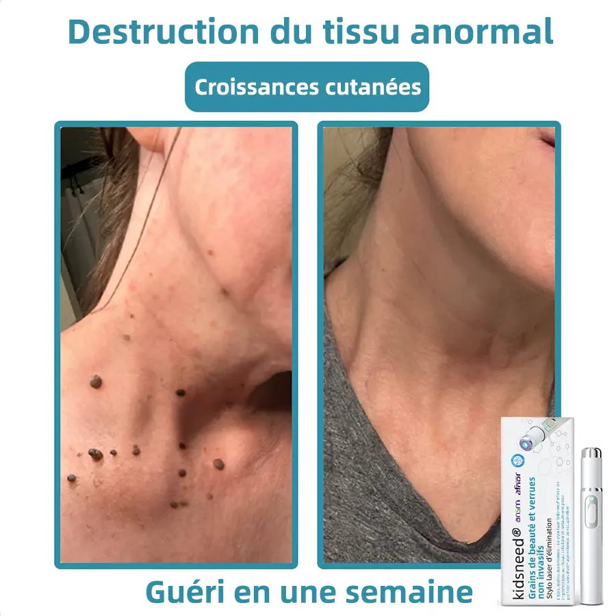 Grains de beauté et verrues non invasifs Stylo laser d'élimination - Image 5