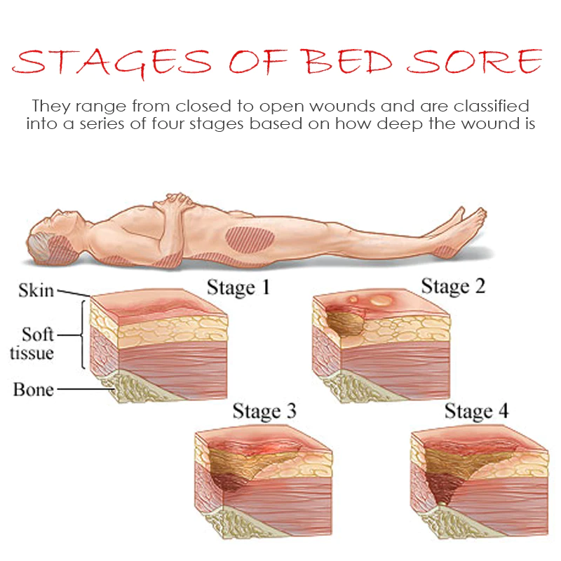 ATTDX BedSores FastHealing TreatmentCream - Image 5