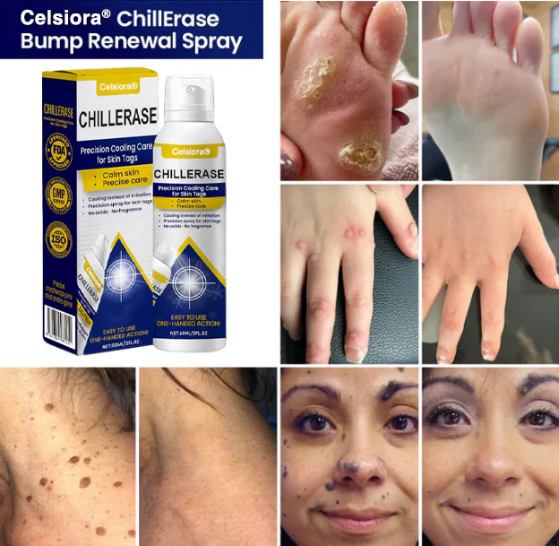 ChillErase Cooling Spray for Skin Tags - Image 5