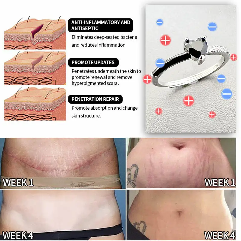 Magnetic Lymp Drainage Health Ring - Image 8