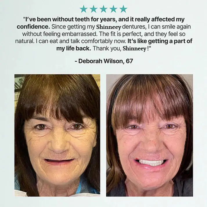 Custom-Fit Full Functional Dentures - Image 12