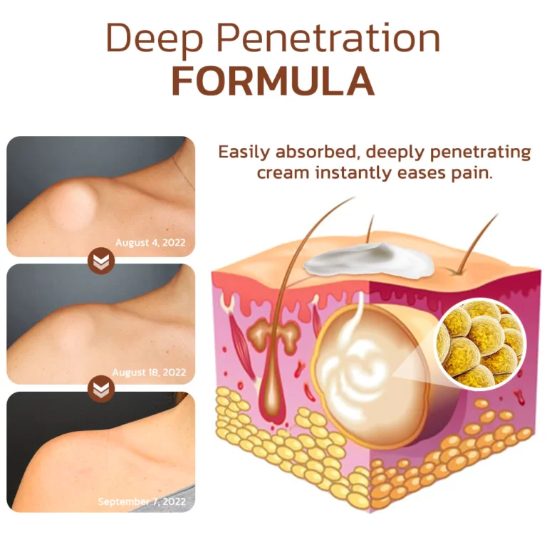 Lumpless Lipoma Treatment Cream - Image 3