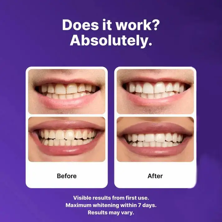 Purple Teeth Whitening Strips - Image 2