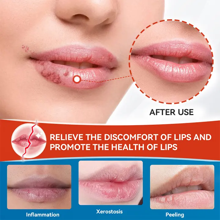 Cheilitis Cream - Image 3