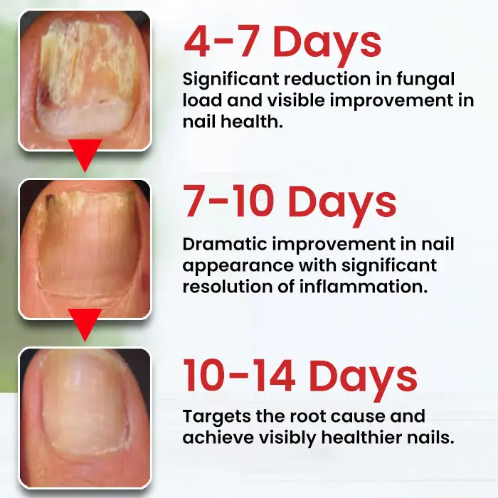 Fungi-Cure Max Fast-Acting Relief for Fungal Nail Infections - Image 4