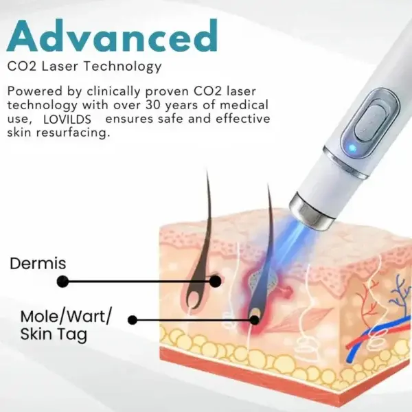 Non-Invasive Mole and Wart Removal Laser Pen - Image 8