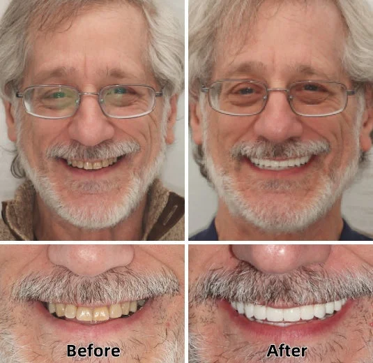 -Advanced Custom-Fit Functional Dentures - Image 4