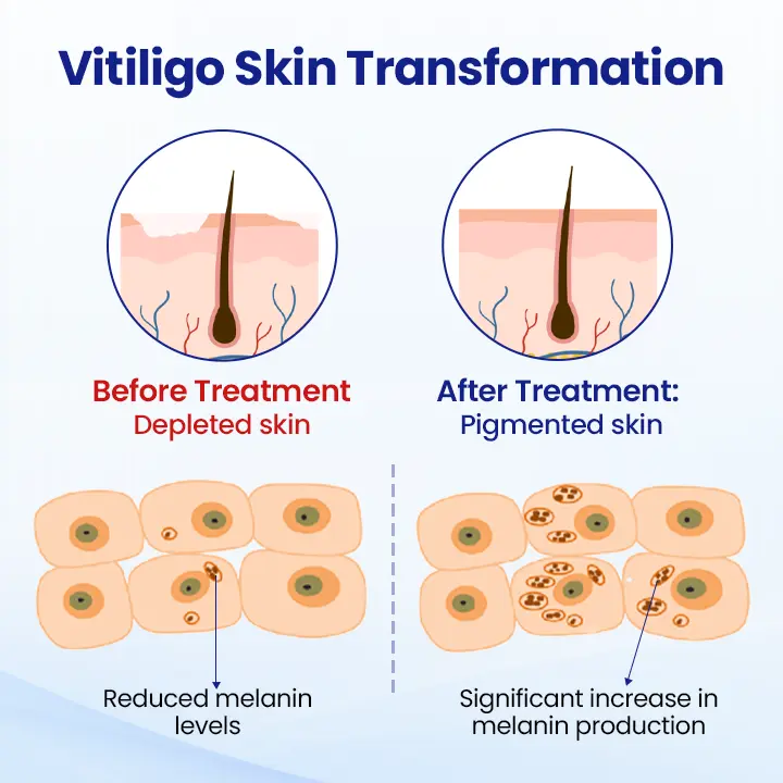 Vitiligo Spray: Psoralen-Powered Relief for White Spots & Irritation - Image 3