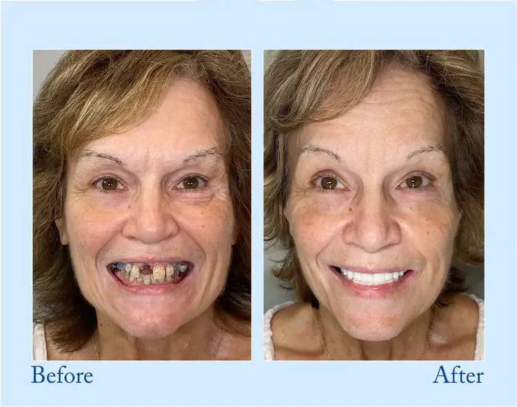 Custom-Fit Functional Dentures - Perfectly Fitted in Minutes at Home - Image 8