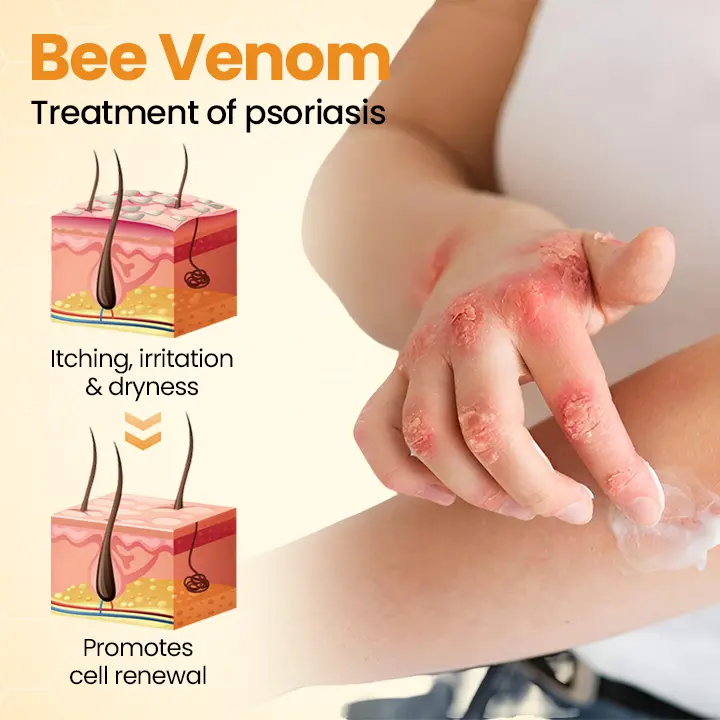 BeeLieve Psoriasis Skin Care - Image 4