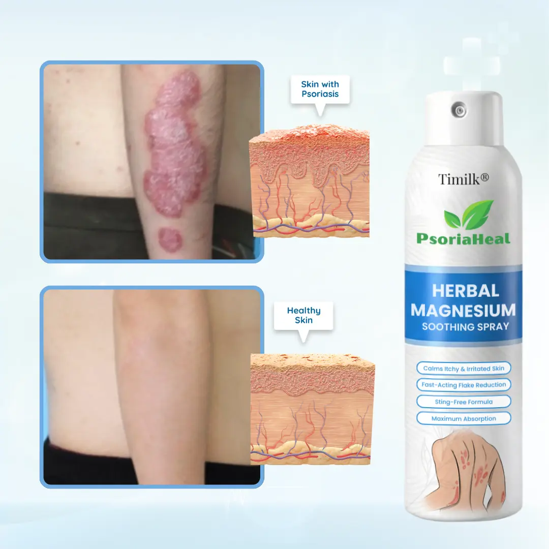 PsoriaHeal Herbal Magnesium Soothing Spray - Image 2