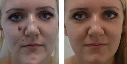 BEE VENOM Wart & Mole Removal Cream - Image 2