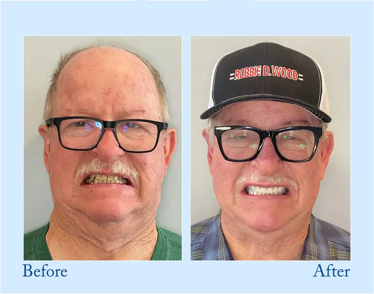 Custom-Fit Functional Dentures – Full Set - Image 7