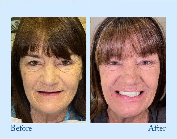 Custom-Fit Functional Dentures – Full Set - Image 9