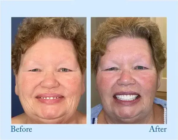 Truease Dentures - Image 11