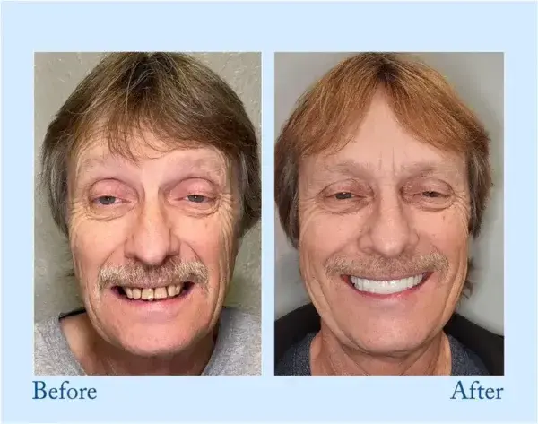 Truease Dentures - Image 9