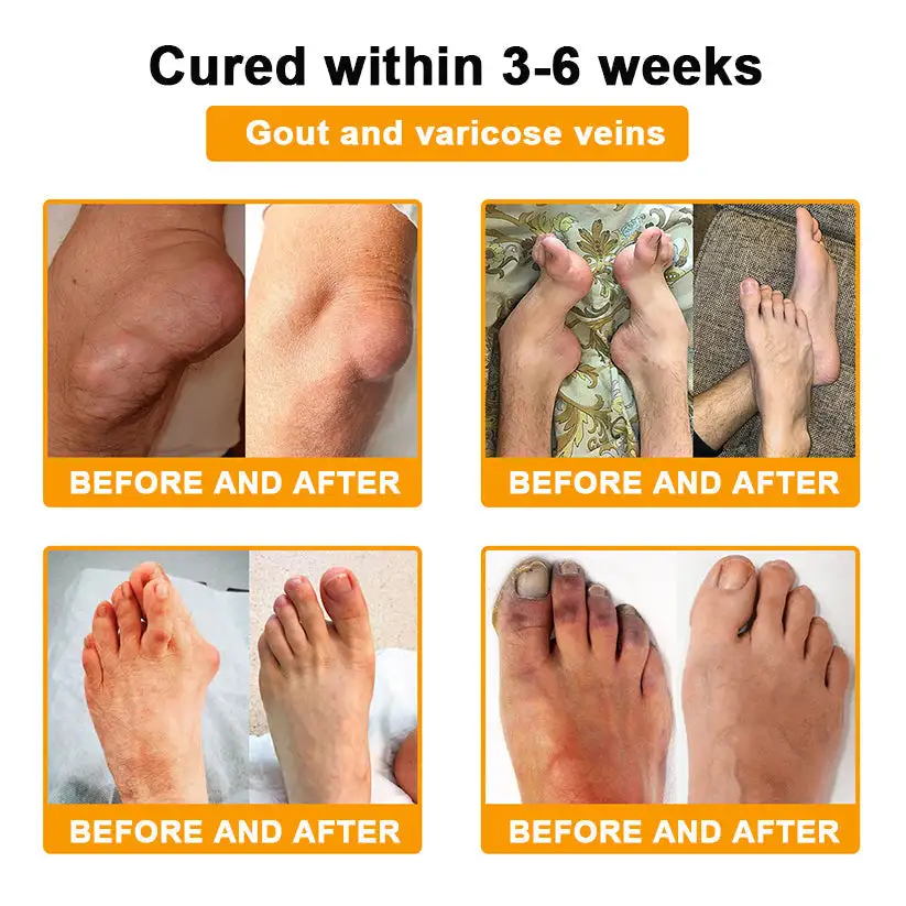 Winter Sale Botulinum Toxin and Bee Venom Pain Relief Bone Healing Cream - Image 9