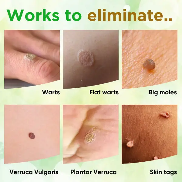 Skin Tag Remover Soap - Image 3