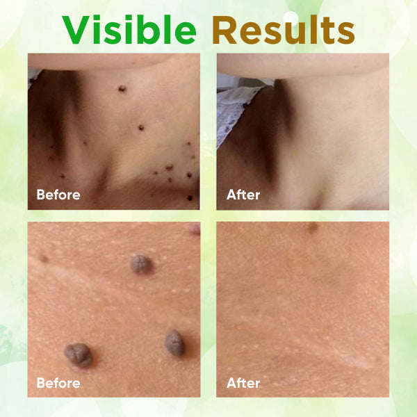 Skin Tag Remover Soap - Image 4