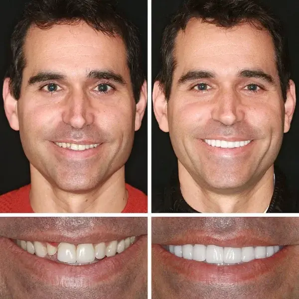 Advanced Customized Full Denture Set - Image 12