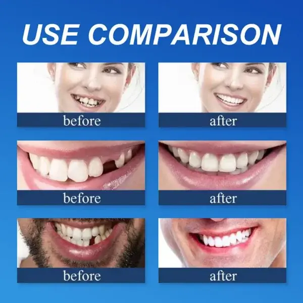 Advanced Customized Full Denture Set - Image 5