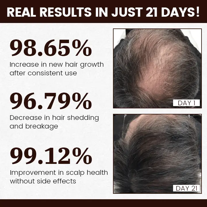 FollicaBoost 5% Minoxidil Hair Care Oil - Image 4