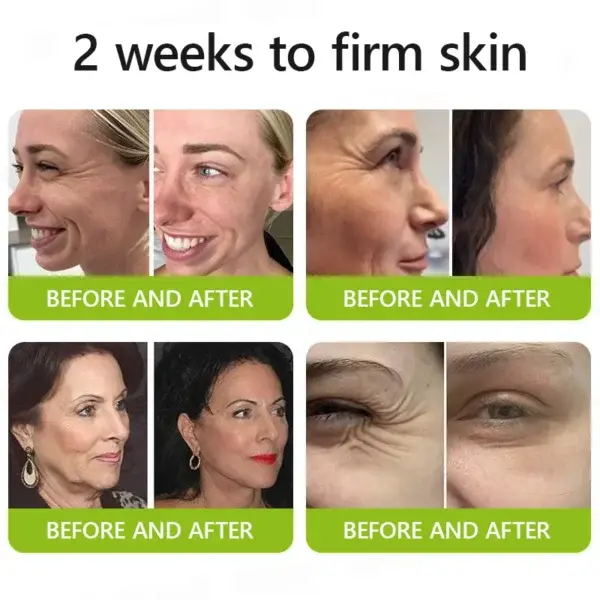 Botox & Retinol Shot - Image 5