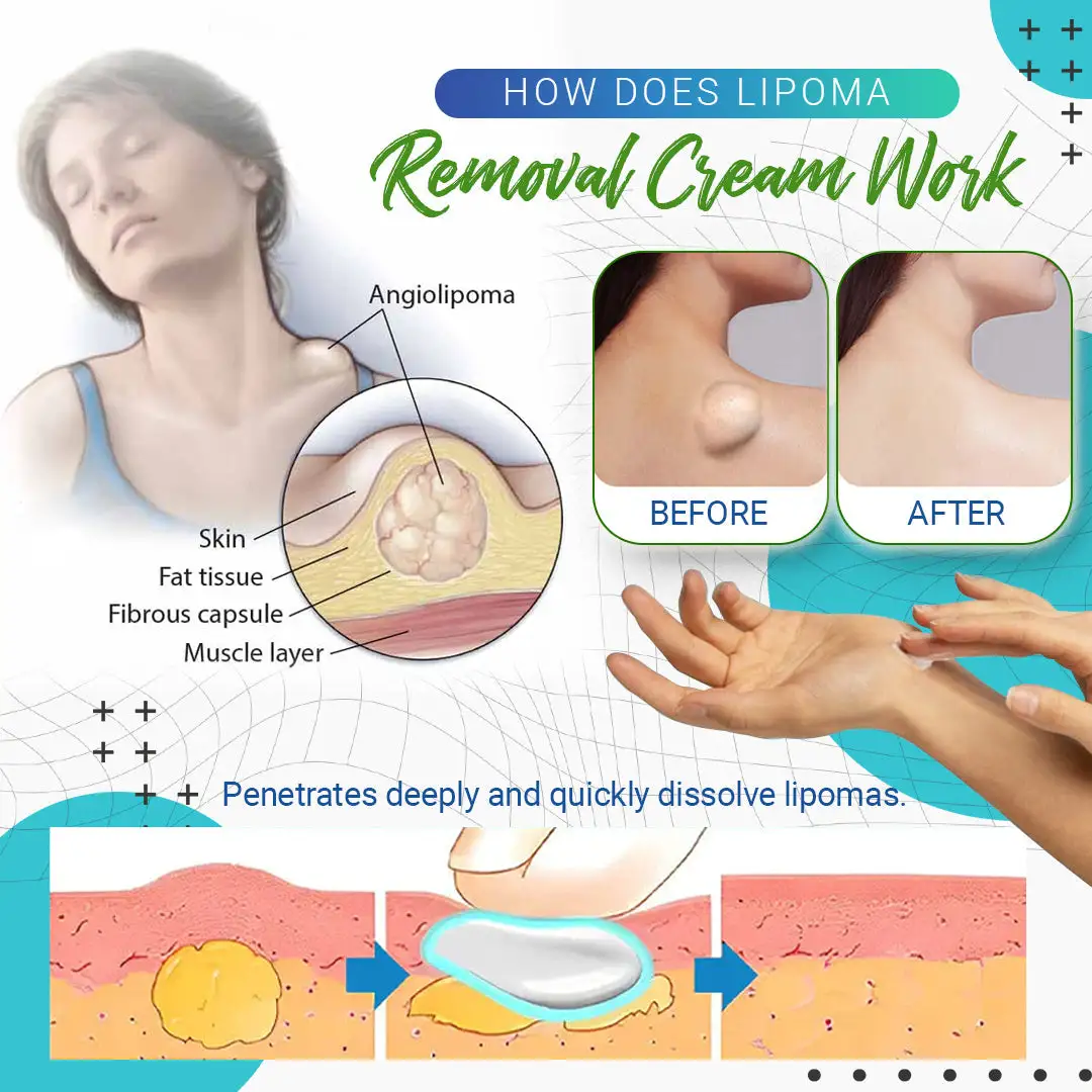 Lipoma Removal Cream - Image 3