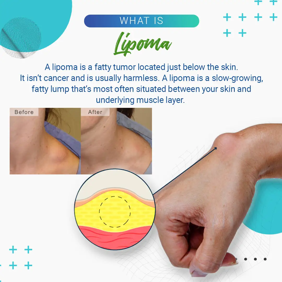 Lipoma Removal Cream - Image 5