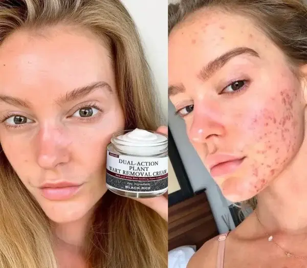 Black Rice Skin Repair Cream – Clinically Tested Wart & Skin Tag Remover - Image 5