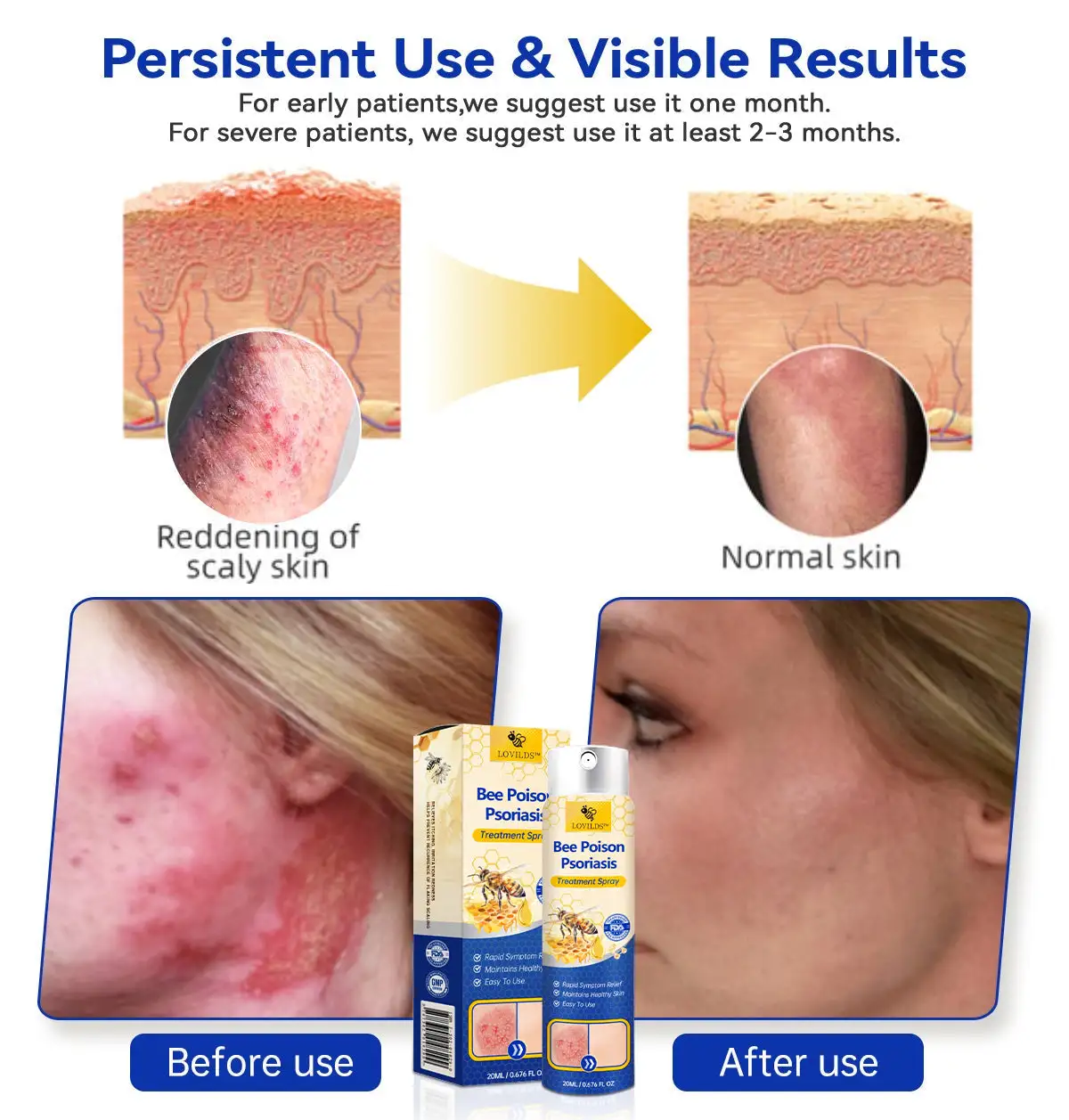 PsoriaHeal psoriasis Spray pro - Image 3