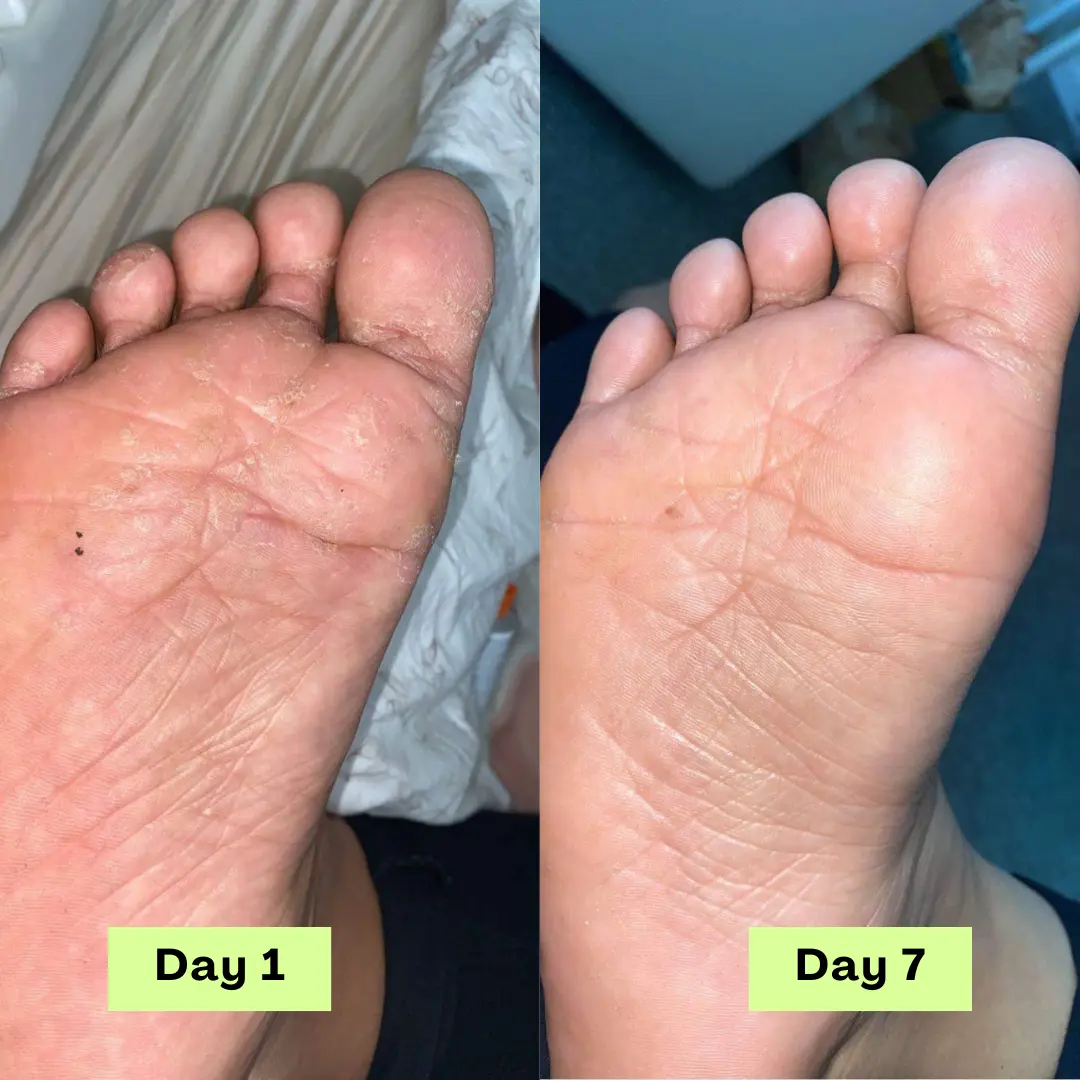 55% off AntiFungal Relief Soap Bar - Image 6