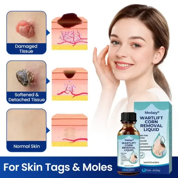 WartLift Corn Removal Liquid - Image 5