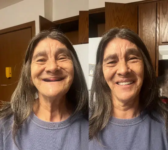 Natural Fit Full Denture Set - Image 3