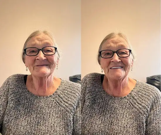 Natural Fit Full Denture Set - Image 4