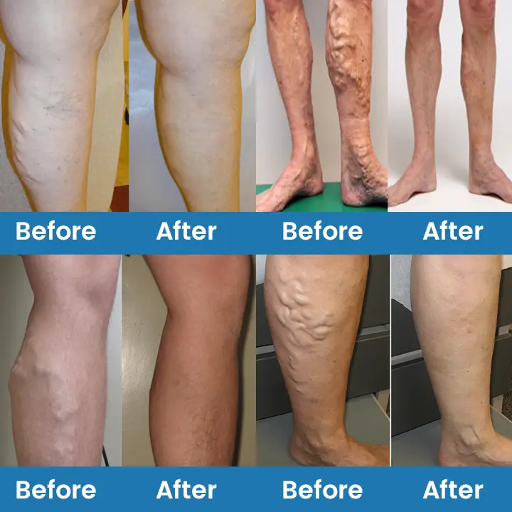 VeinFlow Microneedle Repair Patch - Image 7