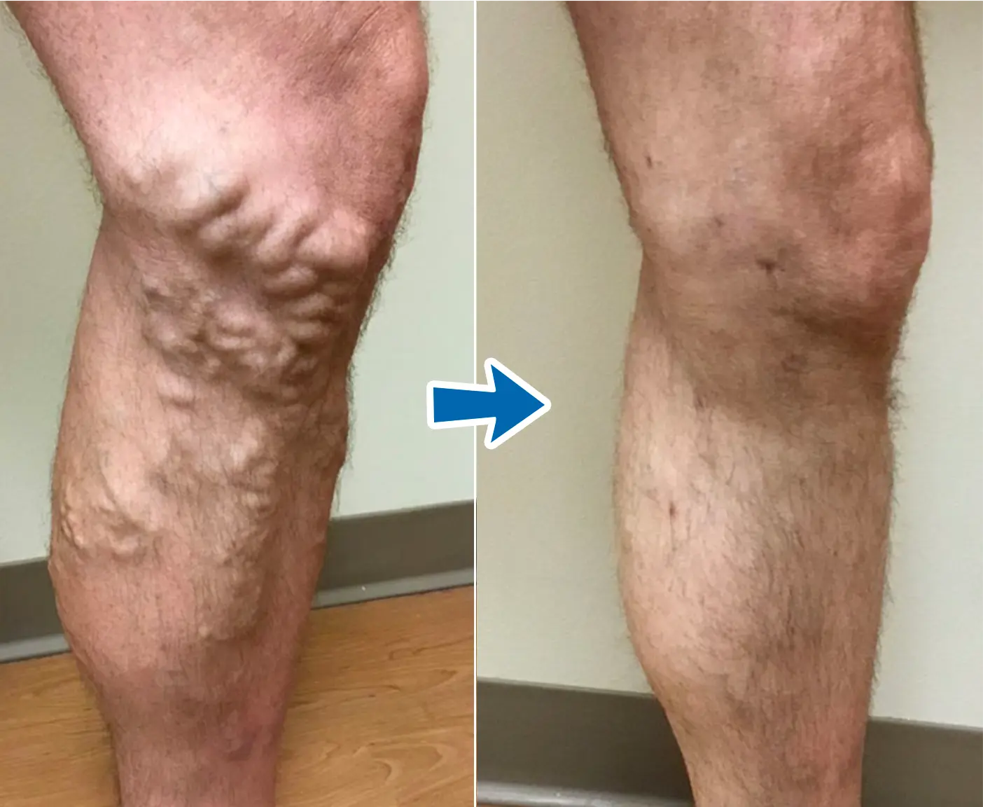 VenoAid Varicose Solution Spray - Image 6