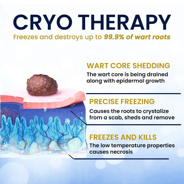 Warts No More - 50% OFF | Skin Tag Cryo Treatment Spray - Image 5