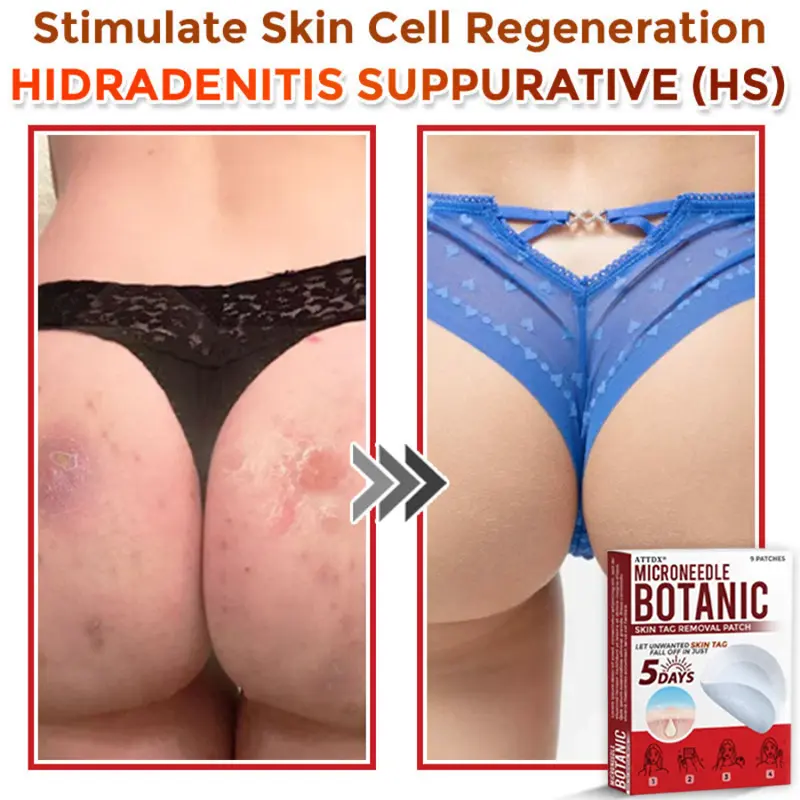 MicroNeedle Botanic Skin Tag Removal Patch - Image 10
