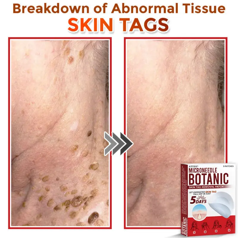MicroNeedle Botanic Skin Tag Removal Patch - Image 7