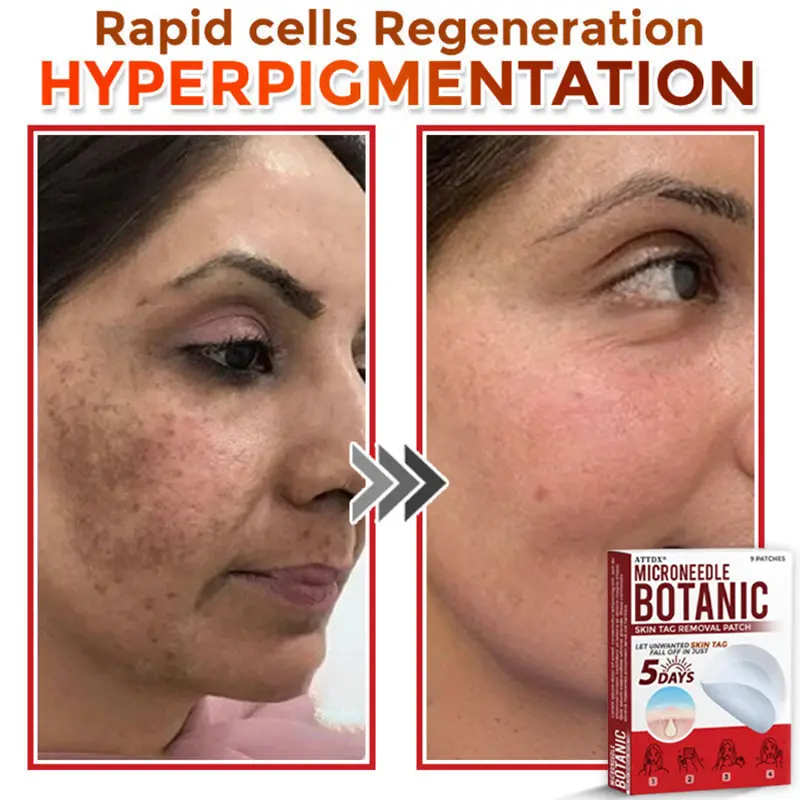 MicroNeedle Botanic Skin Tag Removal Patch - Image 8