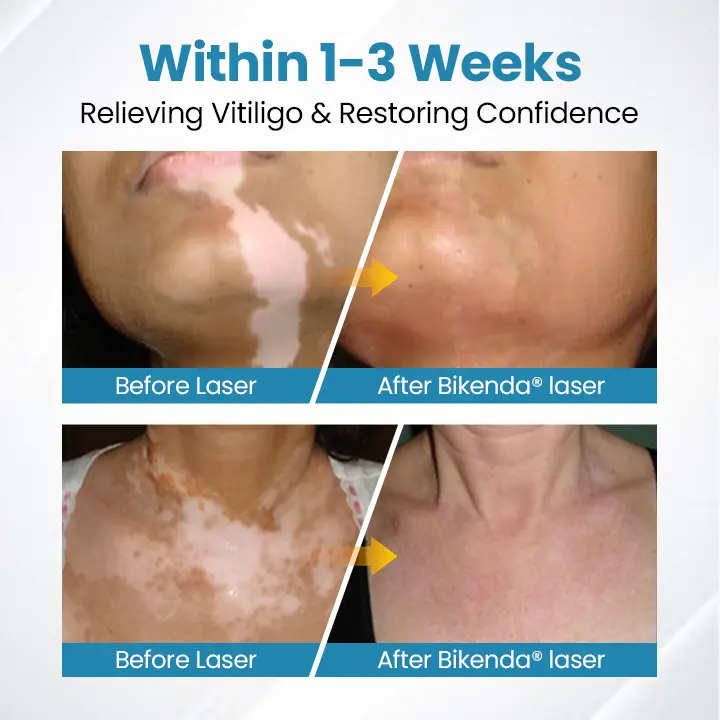 DermaBeam Vitiligo Therapy Device - Image 2