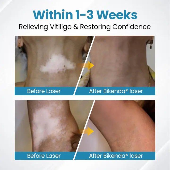 DermaBeam Vitiligo Therapy Device - Image 4