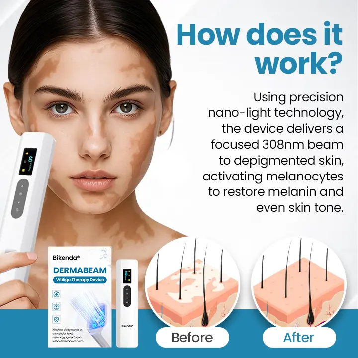 DermaBeam Vitiligo Therapy Device - Image 6