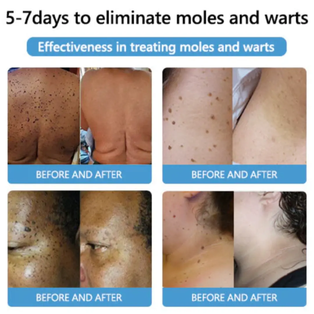 Bee Venom Mole and Wart Treatment Cream - LIMITED-TIME OFFER - Image 12