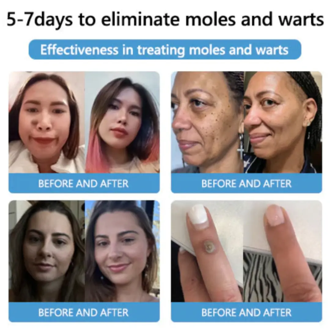 Bee Venom Mole and Wart Treatment Cream - LIMITED-TIME OFFER - Image 18