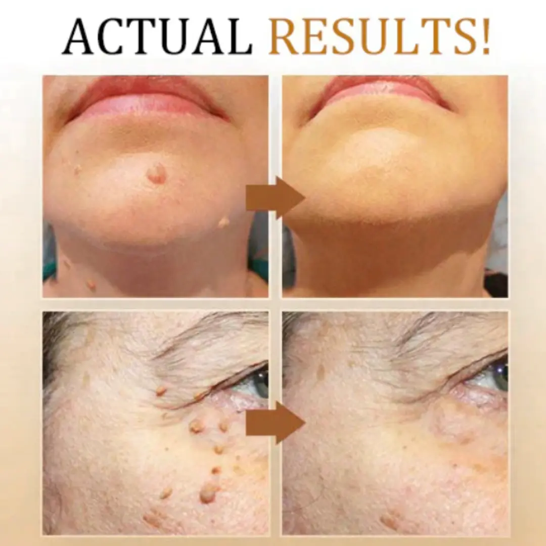 Bee Venom Mole and Wart Treatment Cream - LIMITED-TIME OFFER - Image 20